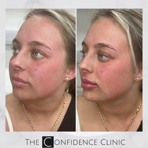 A lovely chin, lips and jawline enhancement to add a little bit of definition and create balance ...