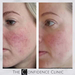 Do you suffer with roseace? 
This lady was getting really fed up with hers until she tried the am...